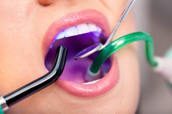 patient with open mouth receiving dental filling drying procedure